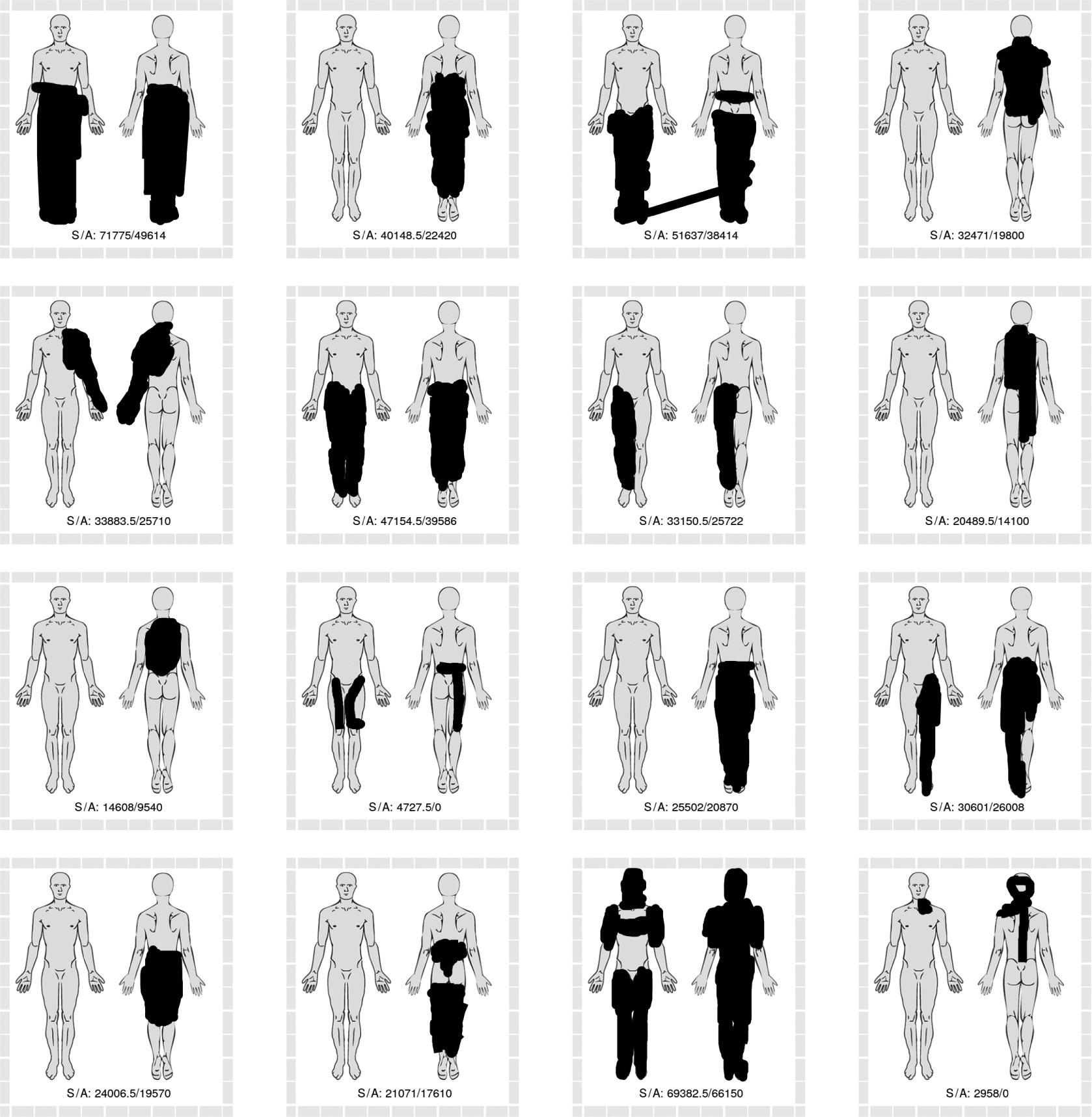 Fig. 10: 
            The sixteen pain drawings with the greatest discrepancy between methods based on raw SVG strokes (greater area estimates) and methods based on anatomical regions (lesser area estimates). Numbers in drawing represent the area sum of the two strokes-based methods (S) and anatomy-based methods (A). Two 0 values represent technical issues in data collection.
          