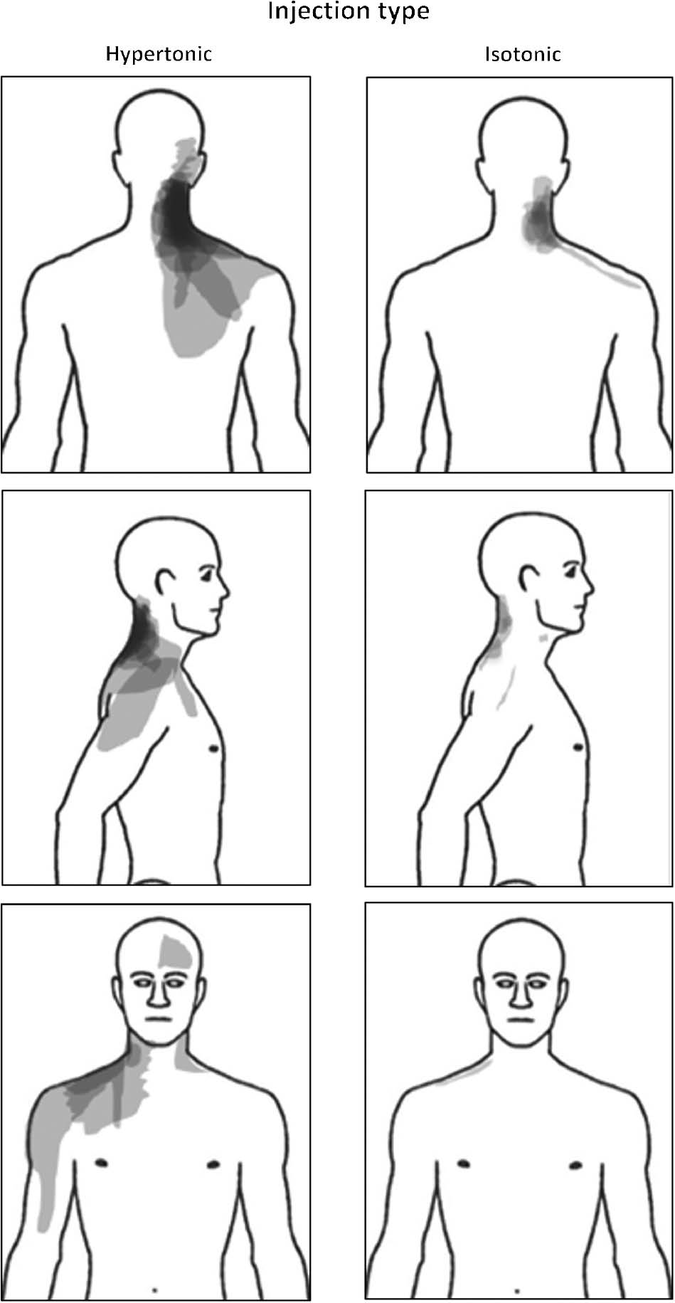Fig. 4:
Superimposed body chart recordings (N=28) during the two experimental conditions following injection of hypertonic or isotonic saline into the right splenius capitis muscle. Darker colour indicates areas that were marked more frequently by participants.