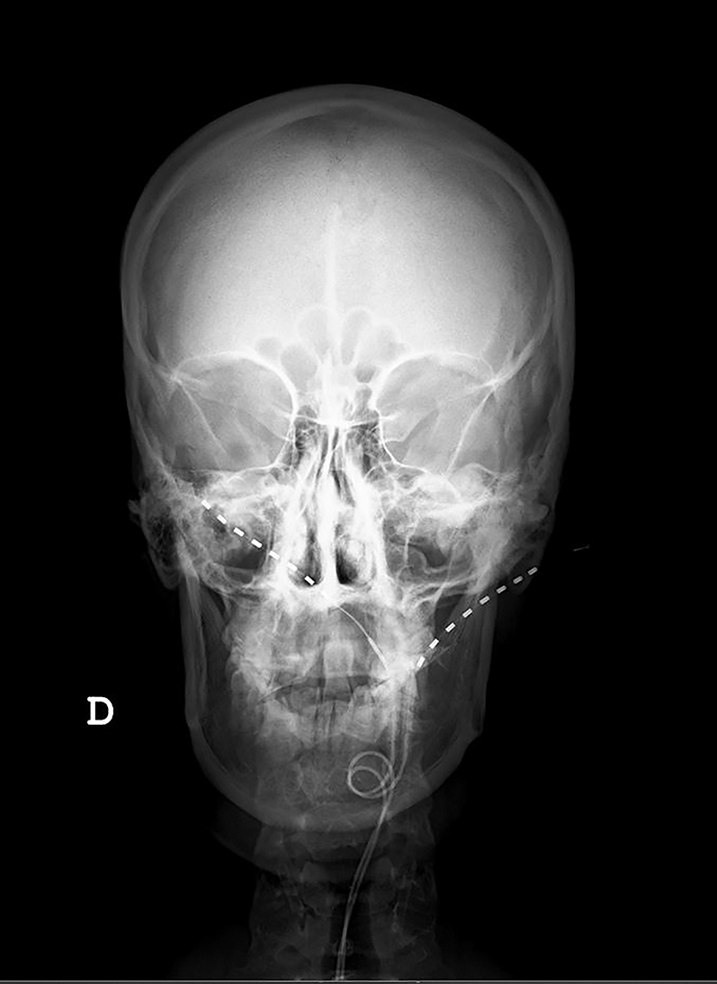 Figure 1: 
          Radiographic scans at initial placement with leads entry point at C1 showing right higher than left placed.
        