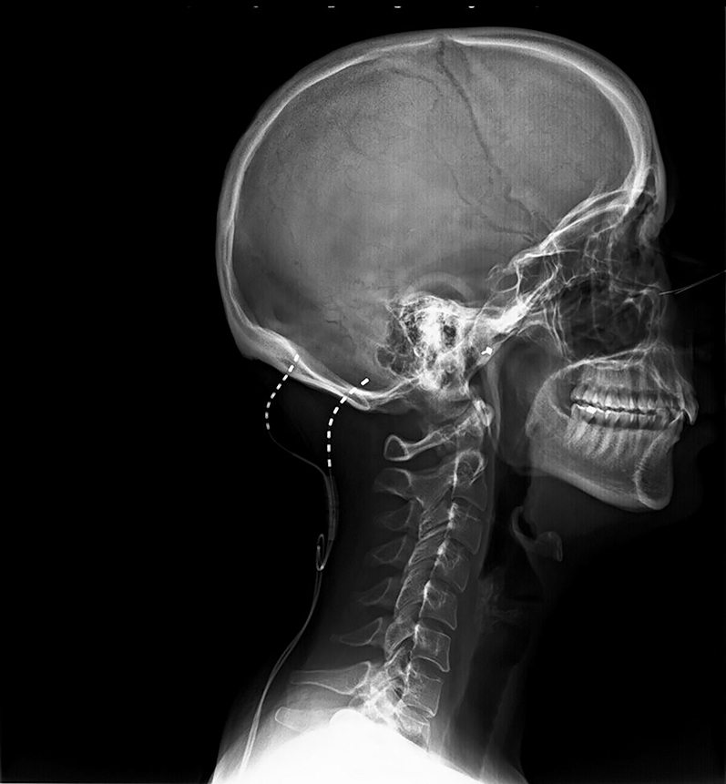 Figure 2: 
          Lateral fluoroscopy view at initial placement with leads entry point at C1.
        