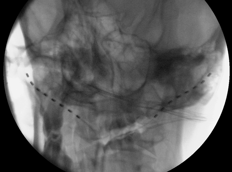 Figure 4: 
          Fluoroscopic image after left lead revision.
        