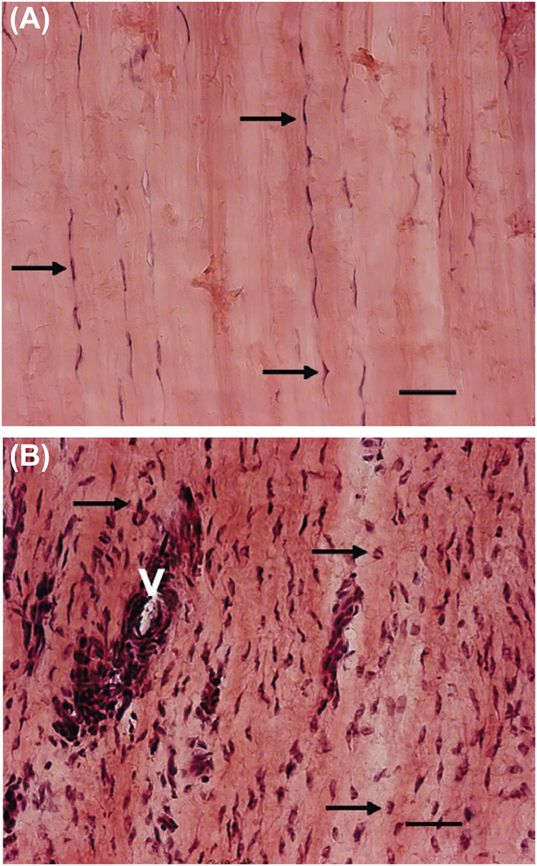 Figure 1: 
            Microscopic anatomy (A-B).
            Micrographs of tendon biopsies from a healthy, painfree individual (A) and from a patient with a chronic painful tendon (B). Hematoxylin and eosin staining demonstrate that the healthy patellar tendon has homogeneous, organized parallel collagen structure and thin, elongated tenocytes (A). In chonic painful tendinopathy, however, collagen disorganization, increased cell count, transformed tenocytes, and vascular ingrowth in the tendon proper are observed (B). Several studies, however, demonstrate no correlation between histological changes and pain [10, 14, 15] or between blood vessel ingrowth detected with power Doppler sonography or contrast-enhanced ultrasound and pain [14, 20], [21], [22], [23]. Hematoxylin and eosin staining. Arrows denote tenocytes. Bar, 50 µm (v=blood vessel). Reproduced with permission from Lian et al. 2006 [28].
          