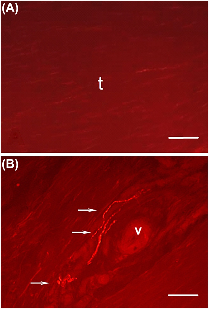 Figure 2: 
            Nerve ingrowth (A-B).
            Immunofluorescence micrographs of Achilles tendon biopsies from a healthy, painfree individual (A) and from a patient with a chronic painful tendon (B). Immunostaining demonstrates that under (A) normal, healthy, conditions nerve fibers do not enter the tendon proper (intra-fascicular matrix). In painful tendinopathy (B) pathological ingrowth of sensory nerves is consistently observed in the intra-fascicular matrix. Nerve ingrowth has been demonstrated in different tendon pain locations such as Achilles tendinopathy [26, 27], patellar tendinopathy [28], rotator cuff tendinopathy [29], tennis elbow [30, 31] as well as in different painful tendon syndromes e.g., calcific tendinopathy [32], frozen shoulder [33].
            Immunostaining of sensory nerve fibers was performed using antibodies against the sensory neuropeptide, substance P. The picture is taken with immunofluorescence microscopy. Arrows denote free nerve endings (v=blood vessel). Bar=50 µm. Reproduced with permission from Ackermann et al. 2012 [81].
          