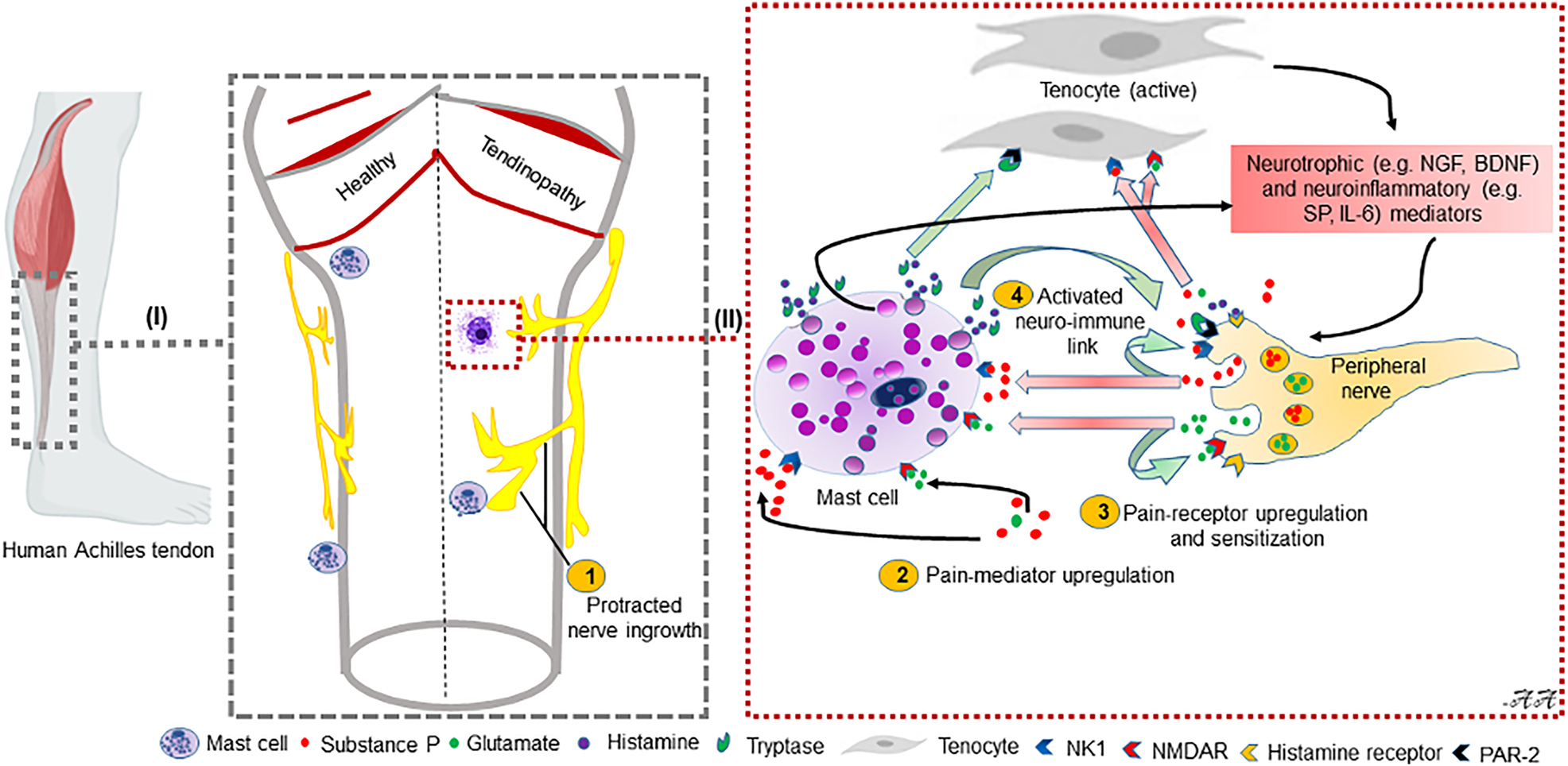 Figure 3: 
            Schematic illustration of pathophysiology in chronic tendon pain.
            In healthy tendons nerve fibers, blood vessels and inflammatory cells are confined to the tendon surrounding structures. Thus, acute inflammation and acute pain may occur in the tendon surrounding structures as paratendinitis, enthesitis etc. In response to e.g, repetitive mechanical stimuli peripheral nerve endings and tendon cells (tenocytes) [82] can release neurotrophic and neuroinflammatory mediators. Neurotrophic factors, such as nerve growth factor (NGF) [53] and brain-derived neurotrophic factor (BDNF), act trophically on nerve endings causing nerve sprouting with nerve fiber ingrowth into the tendon proper. Neuroinflammatory mediators, such as glutamate and substance P (SP), may activate the immune system (specifically mast cells) [83], tenocytes, and peripheral nerve endings via their respective receptors, i.e., glutamate receptors (e.g., NMDAR1) and NK1-receptors. Activated mast cells release proteases, e.g., tryptase, which may functionally impact tendon cells or activate nearby nerves. Mast cells also release NGF, which moreover stimulate upregulation of pain-receptors (e.g., NMDR1) as well as pain mediators (e.g., SP, glutamate) on peripheral nerves. Activated tenocytes moreover drives production of neuro-inflammatory compounds (e.g., SP, NGF, IL-6). SP in turn may activate peripheral nerves (i.e., sensitization) via NK1 receptors in which NMDAR1 becomes activated (phospho-NMDAR1) and cause neurogenic inflammation [84, 85].
            This figure was modified and adapted from Alim et al. 2020 [51]. NMDAR1, N-methyl-D-aspartate receptor type 1; NK1, neurokinin 1.
          