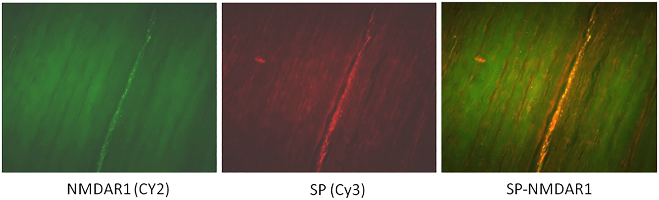 Figure 4: 
            Pain receptor/mediator up-regulation (A-C).
            Micrographs of tendon biopsies from a patient with a painful patellar tendinopathy (A-C). Immunostaining demonstrates expression of the pain receptor (A), N-methyl-D-aspartate receptor type 1 (NMDAR1), on the pathological ingrowth of sensory, substance P (SP) positive, nerves (B) seen in the intra-fascicular matrix. The yellow immunoreactivity shows co-existence of SP and NMDAR1 (C) displayed on the nerve fibers sprouting within the tendon proper. SP was shown to up-regulate NMDAR1 [40] and also to activate NMDAR1 by removing the magnesium block and thereby increasing the excitability of NMDAR1 [43]. Micrographs of longitudinal sections through patellar tendinopathy biopsies stained for NMDAR1 (Cy2 green; A) and SP (Cy 3 red; B) as well as double-stained NMDAR1-SP; NMDAR1-PGP 9.5 co-existence (yellow, merged) respectively. Bar, 50 μm (These figures are previously unpublished).
          