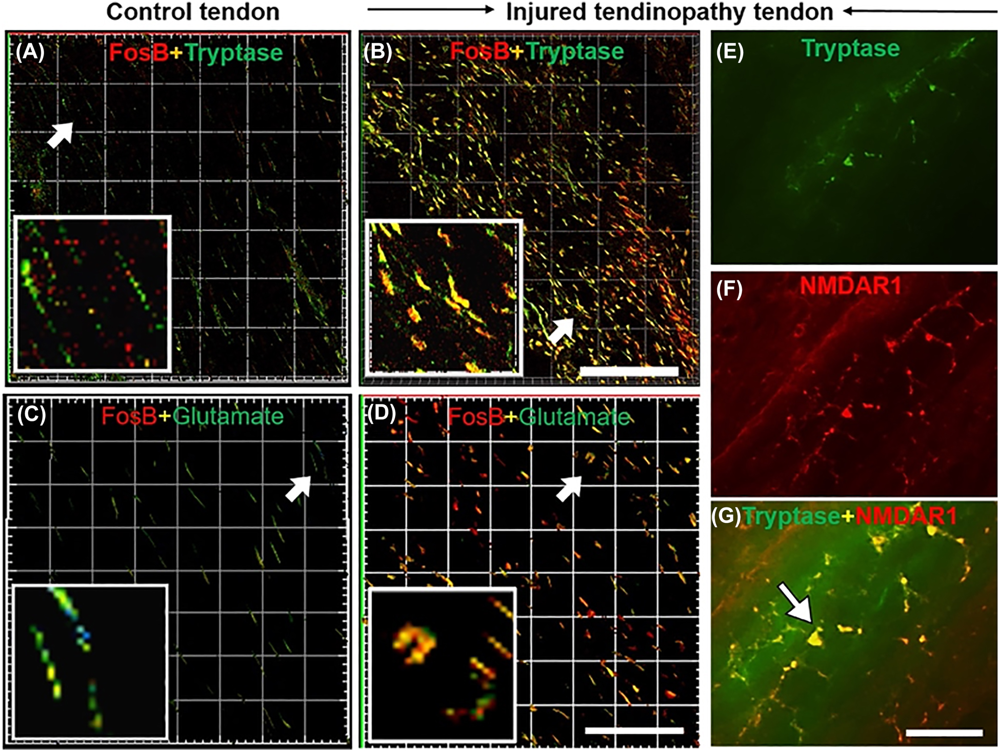 Figure 5: 
            Neuro-immuno connection with transcriptional factor in the control and injured tendinopathy tendon (A-G).
            Immunofluorescence image showing increased colocalization of FosB and MC tryptase (Mcpt6) in the painful injured Achilles tendon (B) compared to the control tendon (A). Immunofluorescence images showing colocalization of FosB and glutamate in the control (C) and painful injured tendon (D). Note the abundance of cells double positive for FosB and glutamate in the injured tendinopathy, but not in the control tendon. In the right panel (E-G), MC tryptase (E, green) and glutamate receptor NMDAR1 (F, red) are colocalized (G, yellow) in the injured tendinopathy tissue. Scale bars: 100 μm. Reproduced with permission from Alim et al. 2017, 2020 [50, 86].
          