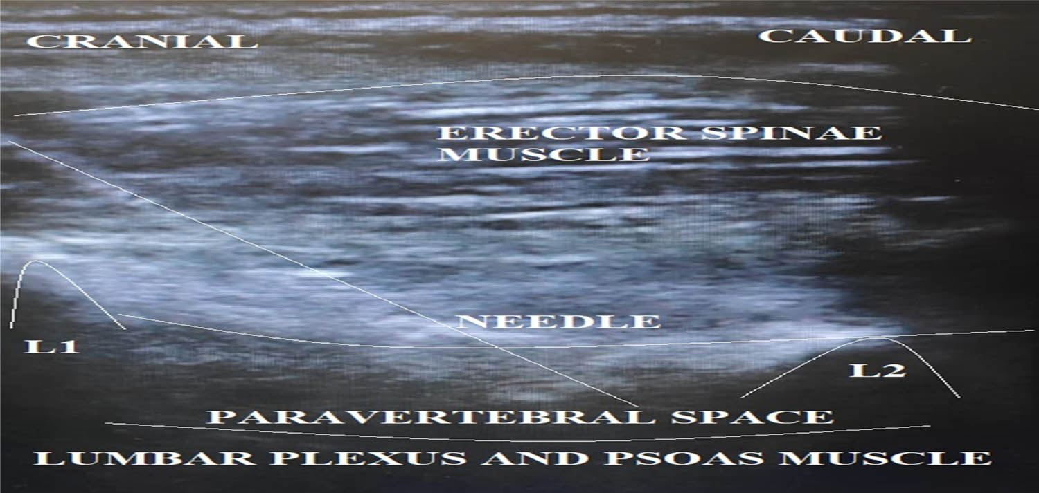 Figure 2 
               Ultrasound image of PVB showing needle, L1 and L2 vertebrae, and paravertebral space.
            