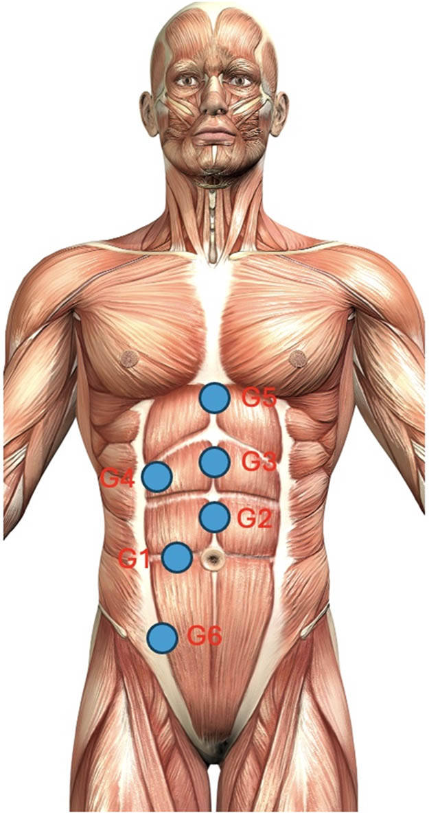 Figure 1 
                  Location of abdominal pressure points and their location on acupuncture points: G1: stomach 25; G2: conception vessel 12; G3: conception vessel 14; G4: gallbladder 24; G5: conception vessel 16; G6: spleen 21. Figure created by the authors using © Freepik (Premium License) resources, modified for the purposes of this study.
               