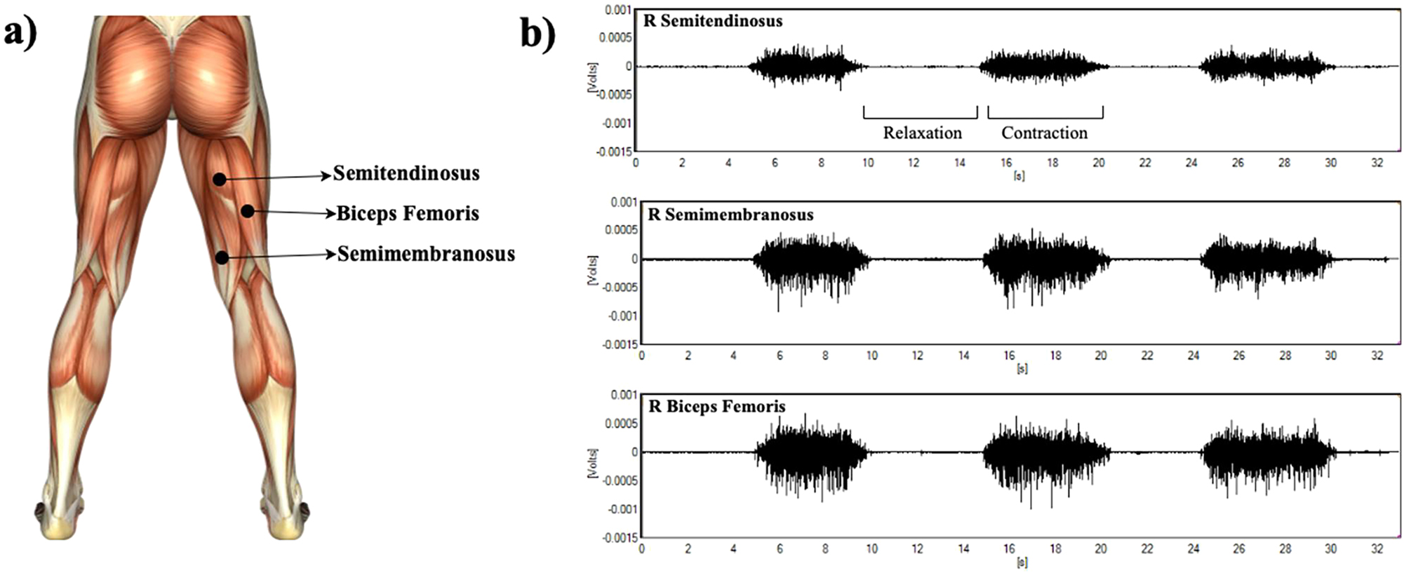 Figure 2: 
Electrode placement and one of a participant’s MVC measurements. a) Placement of EMG electrodes (this muscle map is used as reference which is available in EMGworks software); b) A graphical representation of a participant’s EMG records of ST, SM and BF muscles during MVC measurements (X-axis shows continuous real-time scale of the 5-s contraction phase; the 2-min recovery was excluded for clarity).
