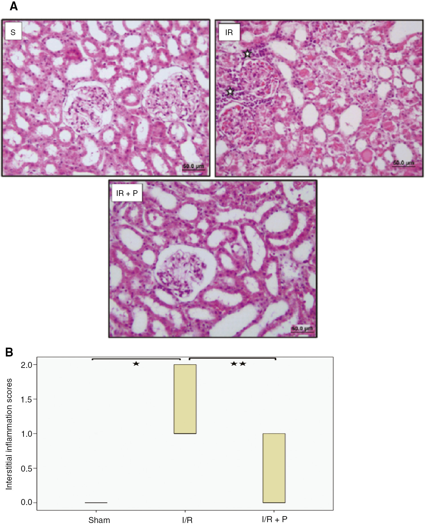 Figure 2: Effect of paricalcitol pretreatment on I/R induced interstitial inflammation.Representative light microscopy images of H-E staining. () indicate mononuclear cell infiltration (A). Box-plot representing the interstitial inflammation scores which were compared among study groups (B). S, sham (n=6); I/R, 45 min ischemia followed by 24 h reperfusion (n=7); I/R+P, paricalcitol administration (0.3 μg/kg) 24 h before I/R (n=7). *p<0.05 vs. S; **p<0.05 vs. I/R, Mann-Whitney U-test.