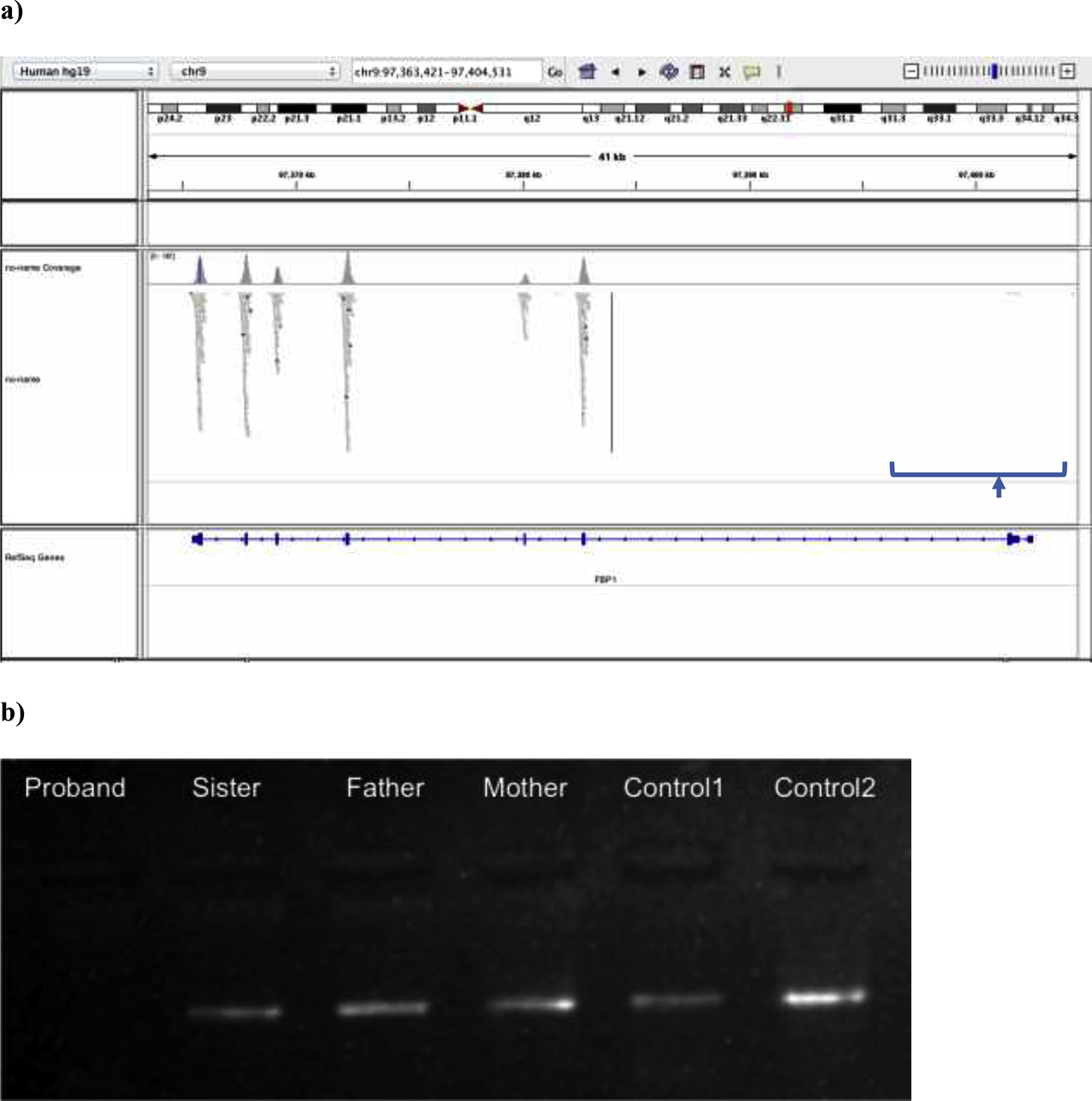 Figure 2: Molecular genetic analysis results of the proband. (a) Integrative Genomics Viewer (IGV) analysis of the patient’s FBP1 sequencing result is shown. Sequence is aligned to reference sequence NM_001127628.2. No reads are obtained from exon 2 of the FBP1 gene, suggesting a gross deletion of the exon. (b) The electrophoresis gel image of the exon-specific PCR analysis to confirm the exon 2 deletion of FBP1 is shown above. Primers were designed within exon 2. Homozygous deletion in the proband (no band) and heterozygous deletions in the mother, father and sister (faint bands) were confirmed by comparison of band intensities with the control bands from a heterozygous individual (Control1-faint band) and from the homozygous healthy individual (Control2-strong band). EtBr signalling under ultraviolet light was used for gel imaging.