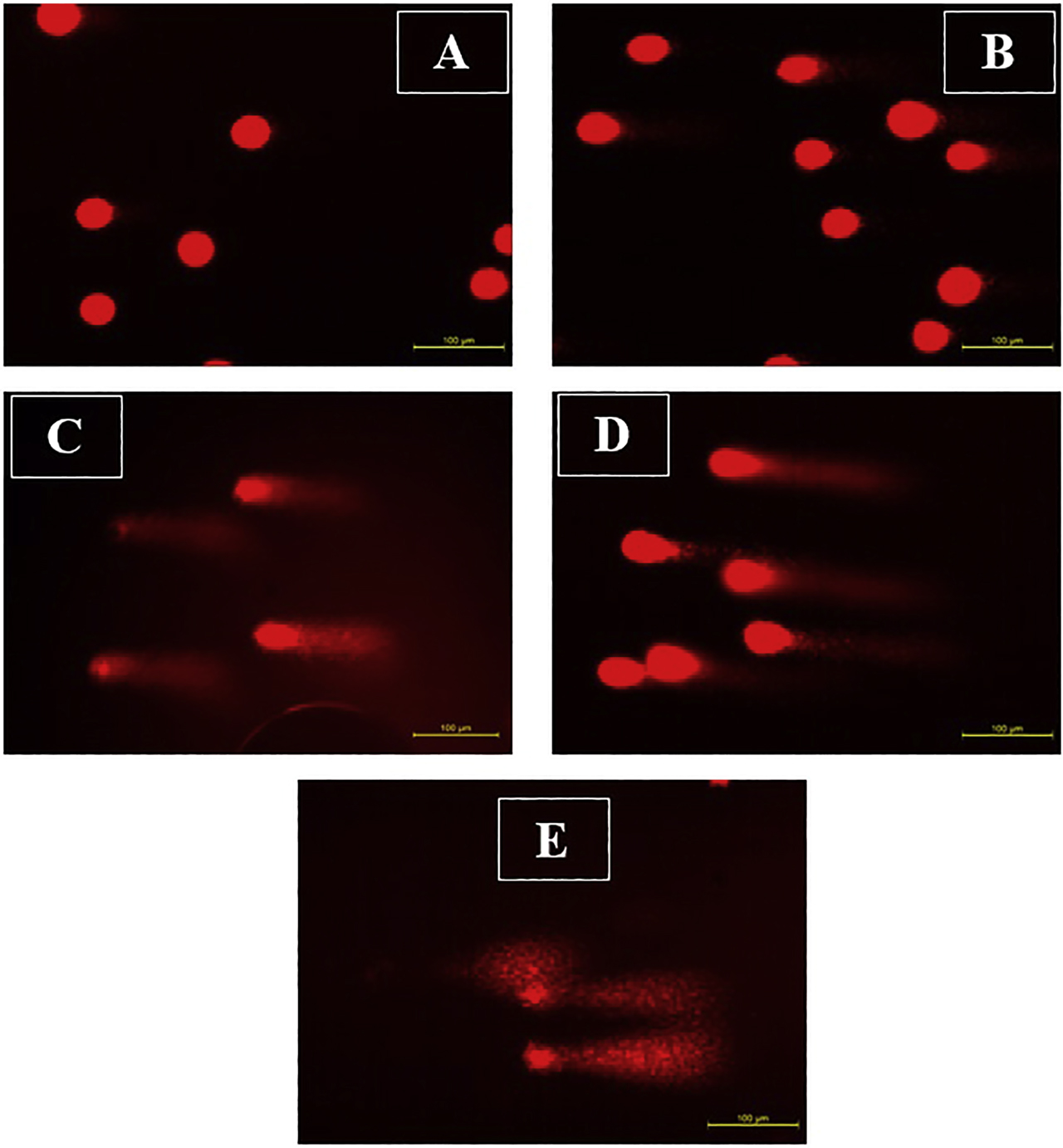 Figure 7: Increased V. opulus concentrations damaged the DNA of Lovo cells. Thus% tail density increased statistically significantly. (A) Control without V. opulus treatment. (B) Treatment with 10 μg/mL V. opulus methanol extract. (C) Treatment with 50 μg/mL V. opulus methanol extract. (D) Treatment with 100 μg/mL V. opulus methanol extract. (E) Treatment with 200 μg/mL V. opulus methanol extract under fluorescence microscope by 200X (Leica). Green color shows the normal morphology of living cells, while the yellow and orange color shows apoptotic cells.