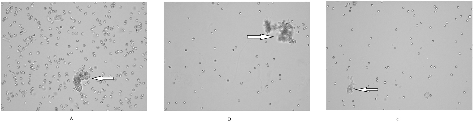 Figure 1:
Most samples were rich in red blood cells. Epithelial cells were seen in groups (A, B) or as single cells (C). Large epithelial cell groups were a feature indicating a neoplastic proliferation. Although unstained, digital images were satisfactory in evaluating cytological features of epithelial cells. It was mostly the single cells that presented cytological features of atypia (c). (High power field images, original sysmex UD-10 images. (A, C) High grade urothelial carcinoma; (B) low grade urothelial carcinoma by pathology reports).