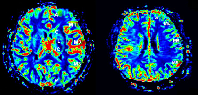 Figure 1 According to the Alberta Stroke Program Early Computerized Tomography Score (ASPECTS) study [12], a normal CT scan of the territory of the middle cerebral artery (MCA) is allotted ten points: cortical regions supplied by the MCA are allotted seven points (one point for insular cortex, M1, M2, M3, M4, M5, and M6), whereas subcortical structures are allotted with three points (one point for C, L, and IC). One point is subtracted for an area of early ischemic change, such as focal swelling, or parenchymal hypoattenuation, for each of the defined regions. A score of zero indicates diffuse ischemia throughout the territory of the MCA. Legend: A, anterior cerebral circulation (blood supplied by anterior cerebral artery); P, posterior cerebral circulation (blood supplied by posterior cerebral artery); C, caudate; L, lenticular nucleus; IC, internal capsule; I, “insular ribbon”; M1, anterior MCA cortex; M2, MCA cortex lateral to the insular ribbon; M3, posterior MCA cortex; M4, M5 and M6 correspond to the anterior, lateral and posterior MCA territories immediately superior to M1, M2, and M3, rostral to basal ganglia.