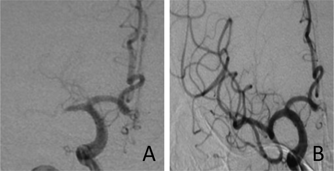 Figure 2 Patient 2 :The MCA M1 occlusive images before and after treatment. In 2a, preoperative DSA imagine is shown on the right side of MCA M1 occlusion. In 2b, imagine displays that the MCA completely was recanalizated.