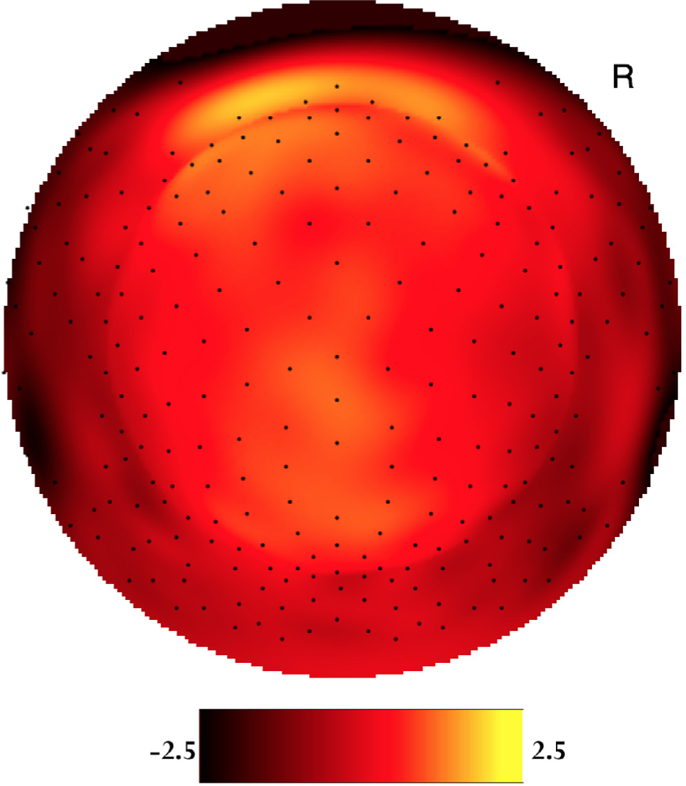 Figure 1 Two-dimensional voltage map of the averaged female P200 waveforms at 200 ms peak latency for the standard (high-probability) stimuli. Bright yellow is positive and dark red is negative (scaled from -2.5μV to 2.5μV). The orientation of the figure is looking down at the top of the head with the nose at the top of the figure.