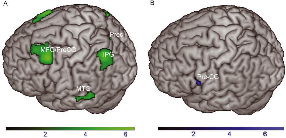 Figure 3 (A) Greater activation to repeated verbs versus new verbs (repetition enhancement) and (B) new verbs versus repeated verbs (repetition suppression) during the lexical decision task. Color range bars indicate T-scores of the respective contrast. Cluster threshold was set to p < .05 (uncorrected). IPG = Inferior parietal gyrus; MFG = Middle frontal gyrus; MTG = Middle temporal gyrus; Prec = Precuneus; PreCG = Precentral gyrus.