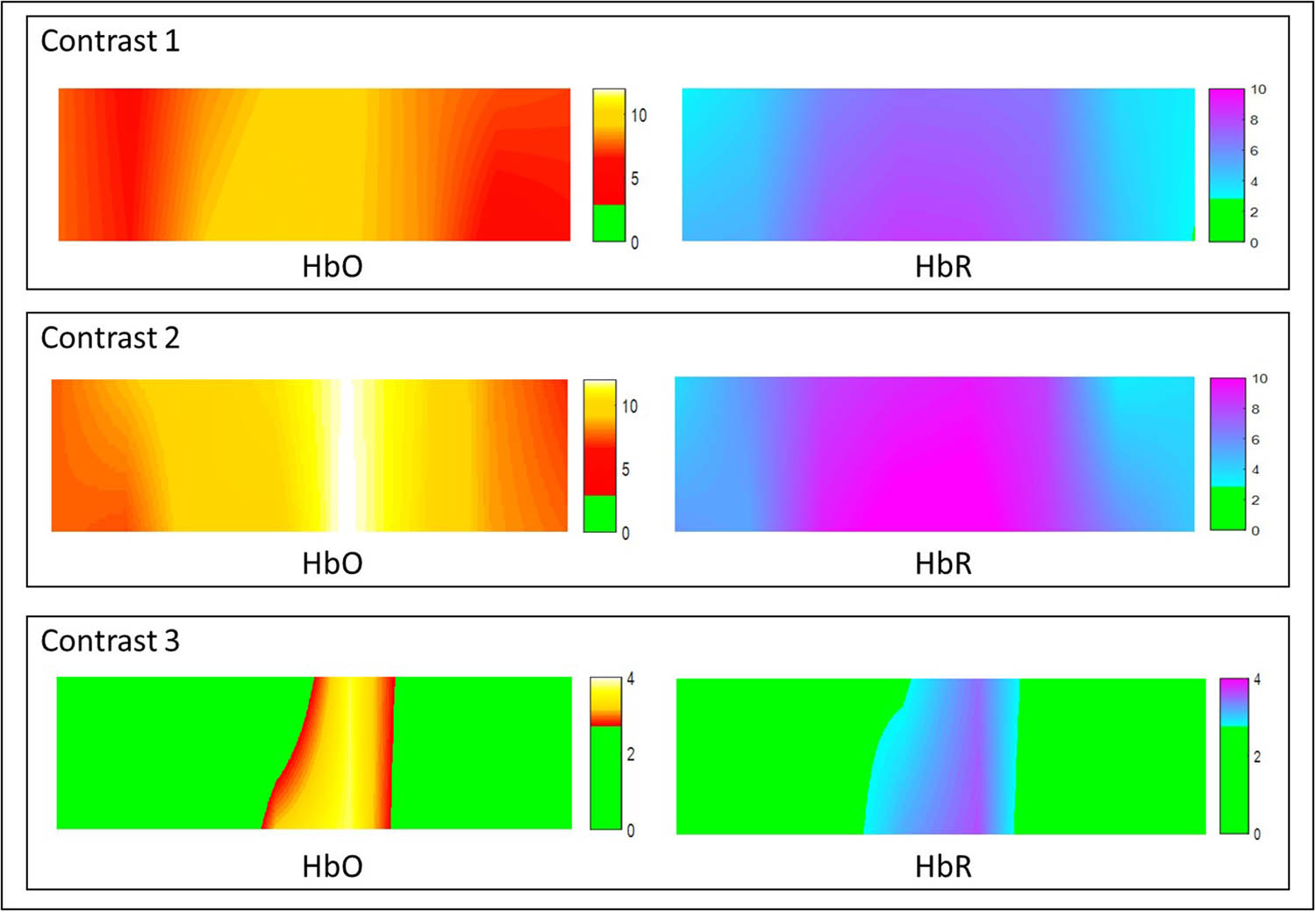 Figure 5 
          Statistically significant interpolated t-maps for HbO and HbR for three contrast models, viz., contrast 1 (step 1 – rest), contrast 2 (step 2 – rest), and contrast 3 (step 2 – step 1). p Value: 0.05 and its corresponding z threshold: 2.69.
        