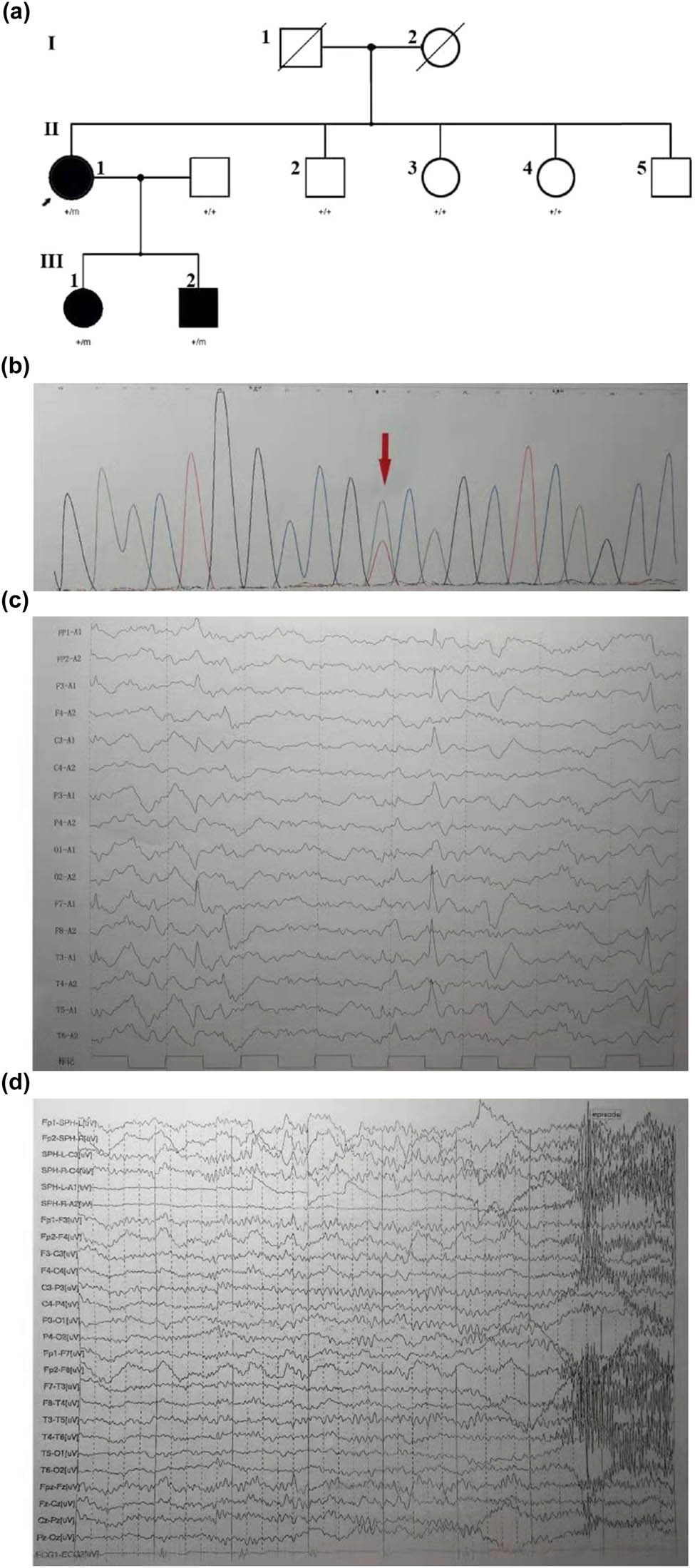 Figure 1
(a) Family pedigree in a novel mutation in KCNT1. The Chinese family includes three affected adults (II: 1, female, 47 years old; III: 1, female, 26 years old, III: 2, male, 17 years old). All subjects (II: 1, III: 1, III: 2) were tested by next generation sequencing. Comparison of the clinical features of the patients with missense mutation at c.2153A>T. (b) The DNA sequencing profile shows the c.2153A>T (p.Asp718Val) mutation in KCNT1. (c) The proband: interictal EEG shows double temporal apical slow waves. (d) The son: ictal EEG examined at 16-year-old. A short EEG seizure discharge begins at the right frontal region. The right anterior temporal, middle temporal, and right sphenoid spike rhythm lasted about 20 s, and then changed to full lead spike rhythm for about 40 s. Paroxysmal clinical manifestations: Sit up suddenly in sleep, lie down 20 s later, and gaze down with excessive movement of torso and proximal limbs, hands flexion and stiff, head left and right wobble, unconsciousness, last for about 48 s, and several similar episodes at night.
