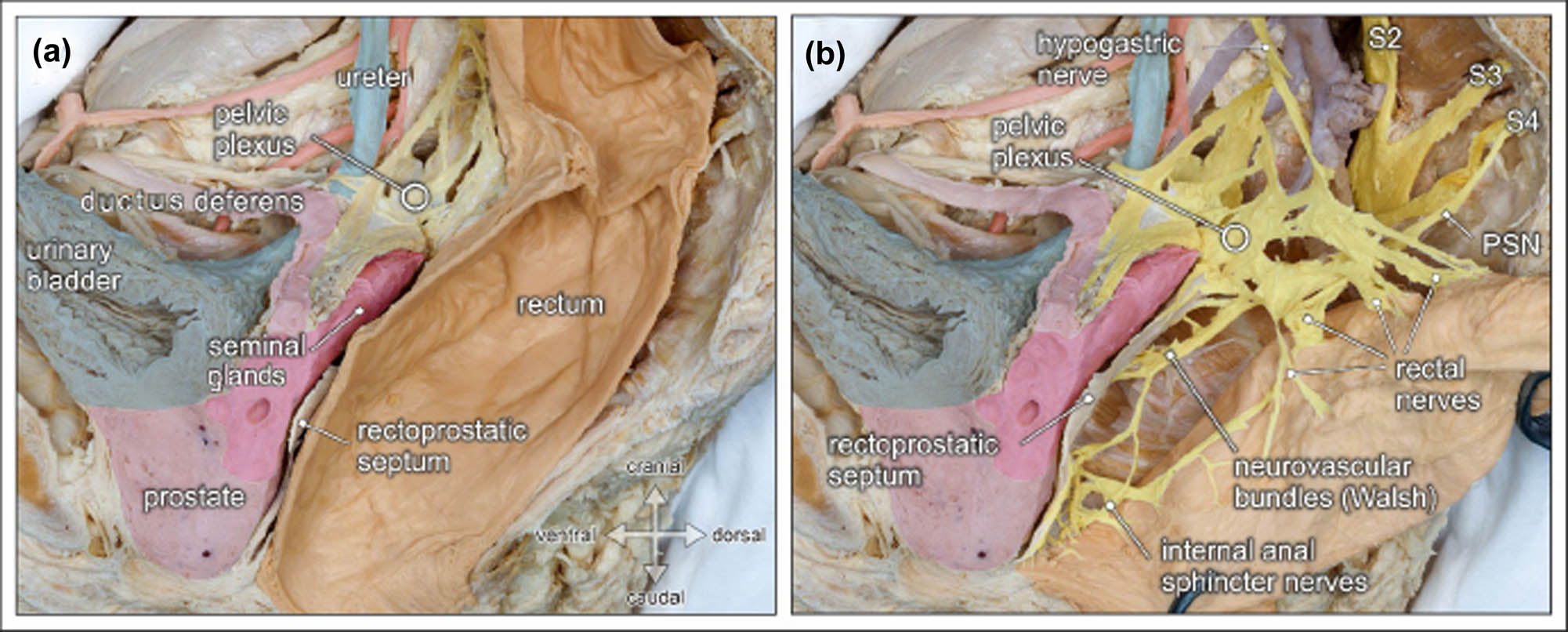 Figure 3 
                     Topographic anatomy of the posterior pelvic compartment. Medial view of a right-sided male hemipelvis. The parietal pelvic fascia is removed to visualize the embedded autonomic pelvic nerves. (a) The posterior pelvic compartment is delimited from the urogenital compartment by the rectoprostatic septum (Denonvilliers’ fascia). (b) The rectum is pulled aside to reveal the inferior hypogastric/pelvic plexus, the hypogastric nerve, and the PSN (PSN, from sacral nerve S4). The inferior hypogastric nerve gives rise to rectal nerves and more caudally to internal anal sphincter nerves, as well as the neurovascular bundle (of Walsh) to the prostate [52].
                  
