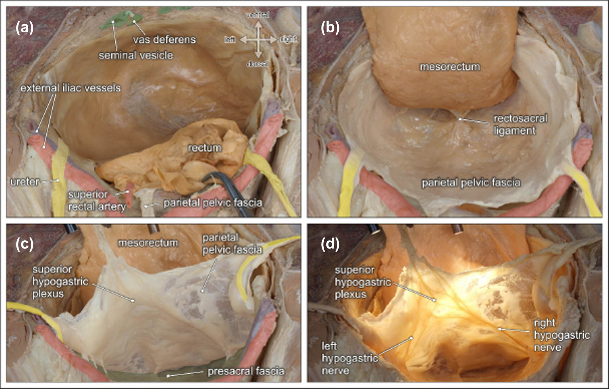 Figure 4 
                     Topographic anatomy of the posterior pelvic compartment. Dorsocranial view of a male pelvis. (a) The rectum and the mesorectum with the superior rectal artery are transected at the rectosigmoid junction (clamp). (b) Dorsolateral mobilization of the mesorectum between the parietal pelvic fascia and the mesorectal fascia along the retrorectal space. Both fasciae are fused by the rectosacral ligament. (c) The parietal pelvic fascia and both ureters are lifted to expose the presacral space behind the presacral fascia. (d) Diaphanoscopy of the parietal pelvic fascia reveals the embedded SHP and both HN [52].
                  