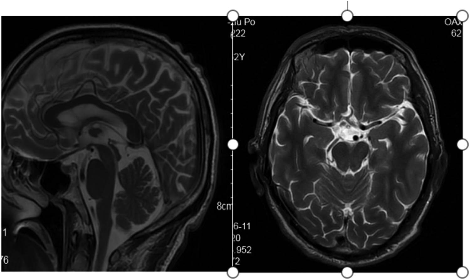 Figure 2
Flat pons, not full and mild cerebellar atrophy in T2-weighted MRI.