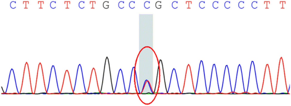 Figure 3
CCDC88C gene mutation sequencing results of II-2, II-3, III-4, III-5, IV-1, and IV-2.