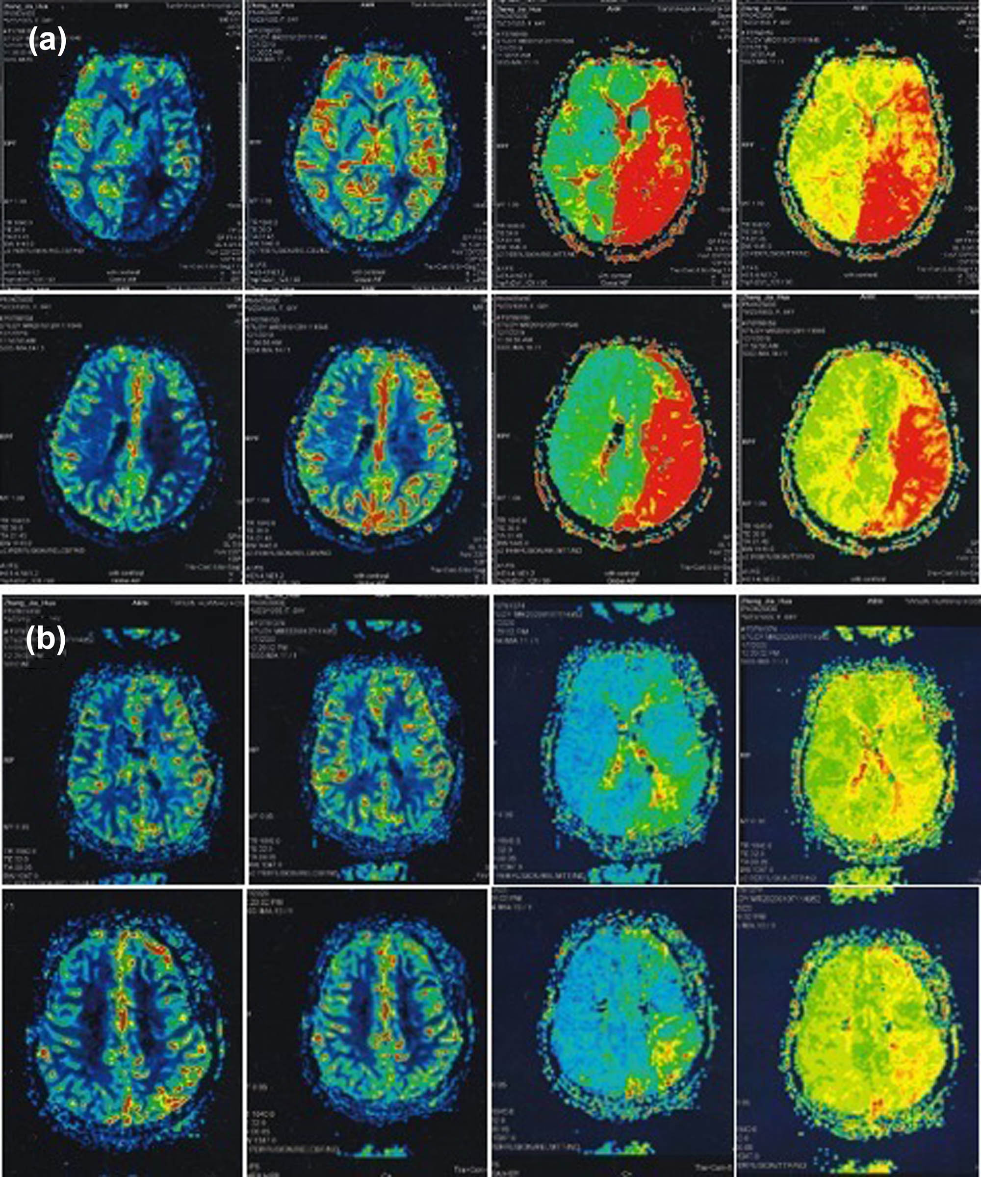 Figure 4 
                  A 64-year-old woman with recurrent ischemic stroke. Cerebral perfusion imaging before (a) and after (b) STA–MCA double bypass.
               