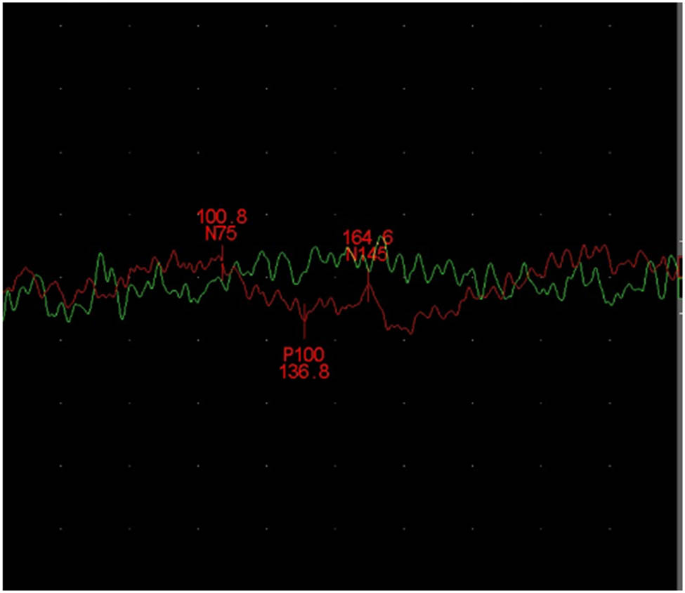 Figure 4 
            The visual evoked potentials latency was prolonged.
         