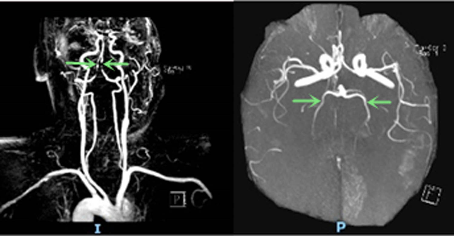 Figure 5 
               Repeat head and neck MRA (25 days after symptom onset) showed persistent stenosis in the bilateral V4 segments of the vertebral arteries and patency in bilateral posterior cerebral arteries (arrow).
            