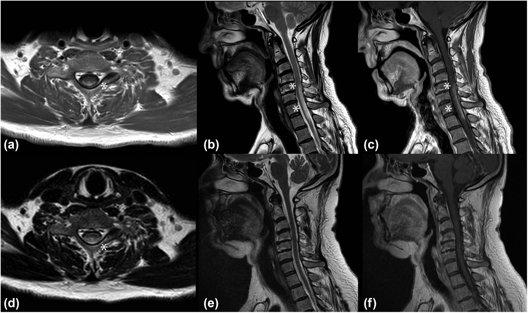 Figure 1 
               (a–d) Spinal MRI at clinical onset. (b) Sagittal T2-weighted image showing the hyperintense lesion extending from C5 to D2 (asterisks); (c) Sagittal T1 post-contrast sequence showing posterior subpial contrast enhancement (asterisks). Axial T1 post-contrast (a) and t2-weighted (d) sequences at symptoms’ onset showing the “trident sign” (asterisk). (e and f) spinal MRI 6 months after treatment. Sagittal T2-weighted (e) and T1 post-contrast (f) sequences showing an almost complete disappearance of the spinal lesion.
            