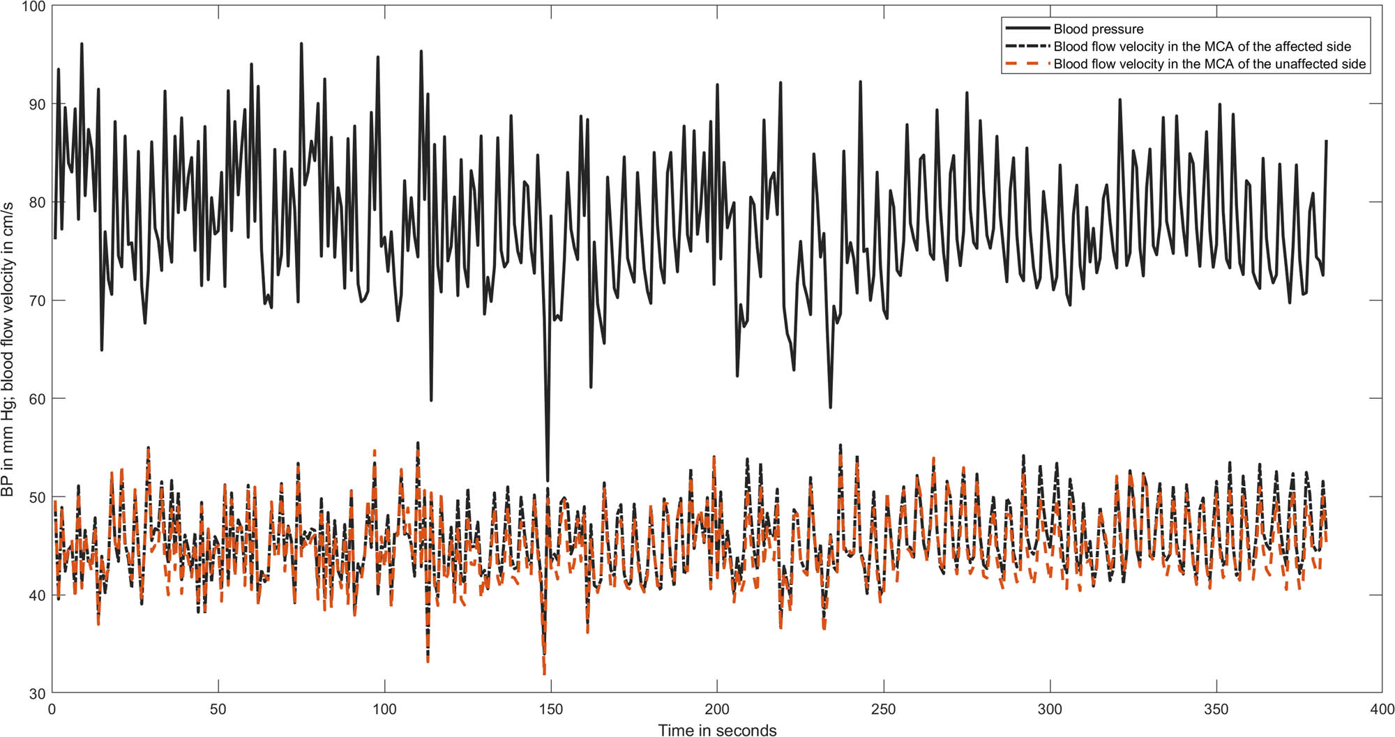 Figure 1 
               A representative recording of BP and MCA blood flow velocity in both hemispheres of a patient with an infarction in the ACA. All time series are averaged over 1 s to reduce the amount of data points. The calculated phase values were as follows: in the very low frequency 0.54 radian in the affected hemisphere and 0.64 in the unaffected one; in the low frequency phase 0.43 in both MCAs.
            