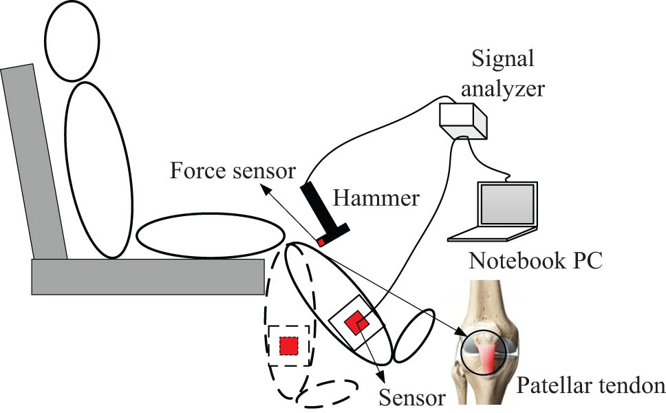 Figure 1 
                  Experimental setup for patellar tendon tapping. The subject sits on a high stool with both feet not touching the ground. A tri-axial accelerometer is fixed on the short leg brace at the medial malleolus. To allow the operator to hit each subject equally hard, a force sensor is mounted on the tip of the hammer. The patellar tendon reflex rating can be read on a laptop computer.
               