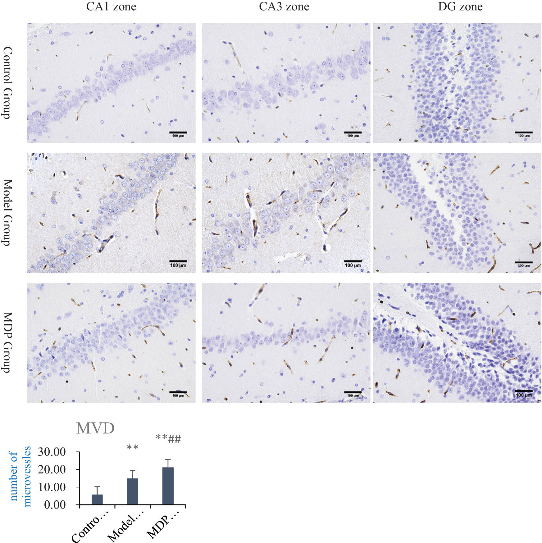 Figure 2 
                  Immunohistochemistry CD43 staining in the hippocampus and MVD analysis. MVD in the model group (14.93 ± 1.92), control group (5.78 ± 1.65), and the MDP group (21.19 ± 2.62). **P < 0.01 vs control group; ##
                     P < 0.01 vs the model group.
               