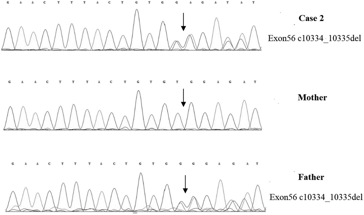 Figure 5 
                  
                     VPS13B Exon56 c10334_10335del heterozygous deletion in case 2, carried by the father, but not detected by the mother.