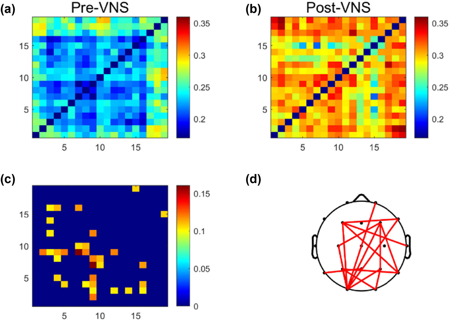 Figure 1 
                  VNS-induced changes of the brain functional connectivity in the full-frequency band (0.5–45 Hz) EEG. (a) Brain correlation matrices before VNS treatment. (b) Brain correlation matrix after VNS treatment. (c) Functional connection matrices with significant differences. (d) Functional connections with differences were mapped to the brain topology.
               