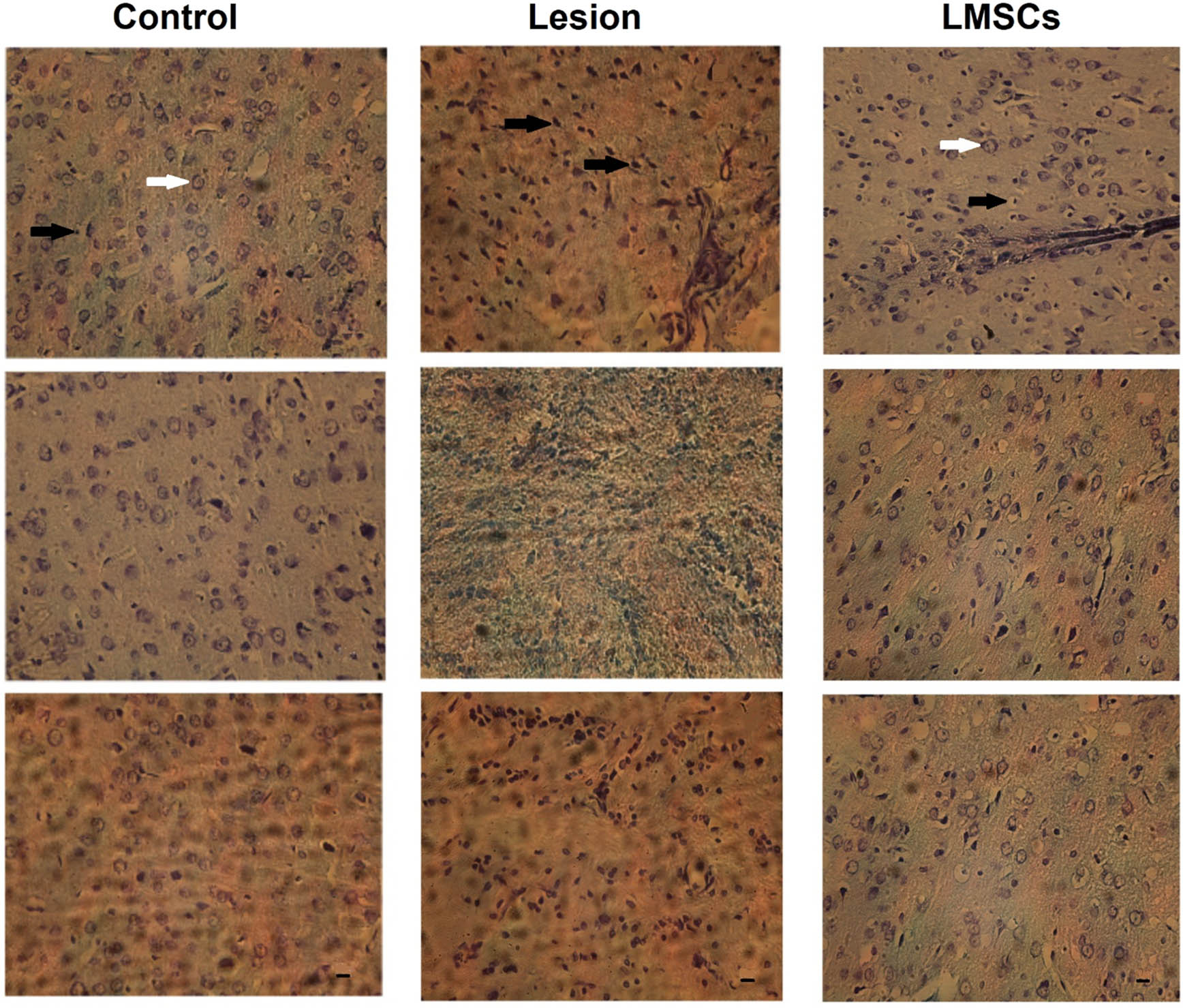 Figure 5 
                  Neurons in the barrel cortex area, characterized by clear and visible nuclei and nucleoli, were considered viable and intact cells (white arrow). Depicted the degenerative cells (DC) had dark and pyknotic nuclei, dense and dark cytoplasm as (black arrow) in the lesion group increased compared to the control and LMSCs groups (magnification ×400).
               