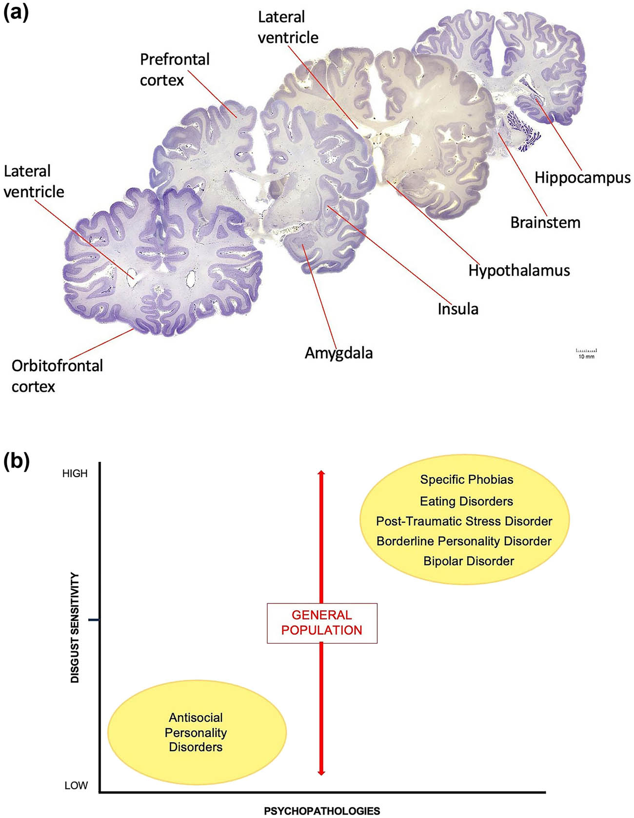 Figure 3 
               (a) Coronal sections of the human brain. (b) Schematic graph illustrates differences in the intensity or degree to which disgust is experienced in several psychiatric disorders relative to the general population. Subjects diagnosed with psychopathy display a number of aberrant behaviors that are potentially linked to certain anatomical regions of the brain (a). For example, neurons of the prefrontal, orbitofrontal, and insular cortices, neurons of the amygdaloid complex, hypothalamic neurons, and neurons of the medullary reticular formation (within the brain stem) establish synaptic connections both within and with other nerve cells to form distinct circuits underlying normative and perhaps psychopathic behavior. It is now thought that damage to the chemical synapse or circuit formation during development could lay the foundation for personality disorders. The degree of shared brain regions between disgust and psychopathy suggests that the same discrete biology could underlie both personality traits. We hypothesize that disgust sensitivity is apparently absent or downregulated in subjects diagnosed with psychopathy. In sharp contrast, however, increased or heightened sensitivity levels of disgust are frequently diagnosed in other personality disorders (b). While social and cultural factors certainly contribute to these differences, a broad range of physiopathogenic mechanisms within the behavioral spectrum of each syndrome may also be involved. Although impulsivity, hostility, obsessive–compulsive characteristics, affect dysregulation, personality dissociation, and other obtrusive temperamental traits might be shared by both psychopaths and patients with different psychiatric disorders, levels of disgust sensitivity (X-axis on the schematic graph) appear to considerably differ among certain psychopathologies (Y-axis on the schematic graph). Human brain sections were obtained from the Michigan State University, Brain Biodiversity Bank; supported by the National Science Foundation.
            