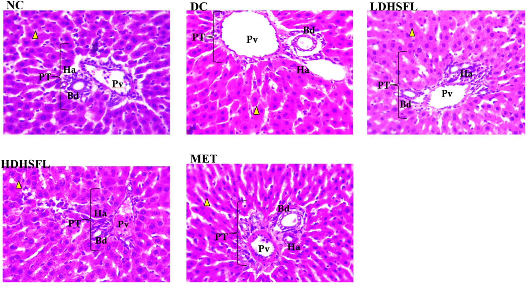Figure 7:
Liver histoarchitecture in STZ-induced diabetic rats after administration of flavonoid-rich H. sabdariffa leaf extract, showing the hepatocytes (yellow arrowhead) and portal triad (bile duct, hepatic artery, portal vein). NC, normal control with normal pyknotic hepatocyte nuclei and portal area; DC, diabetic control with dilation of the blood vessels and vacuolations of the hepatocytes; LDHSFL, diabetic rats given a low dose (150 mg/kg body weight) of flavonoid-rich extract of H. sabdariffa, with normal pyknotic hepatocyte nuclei and portal area. HDHSFL, diabetic rats given a high dose (300 mg/kg body weight) of flavonoid-rich extract of H. sabdariffa, with normal pyknotic hepatocyte nuclei and portal area. MET, diabetic rats given 200 mg/kg of metformin, with normal pyknotic hepatocyte nuclei and portal area.