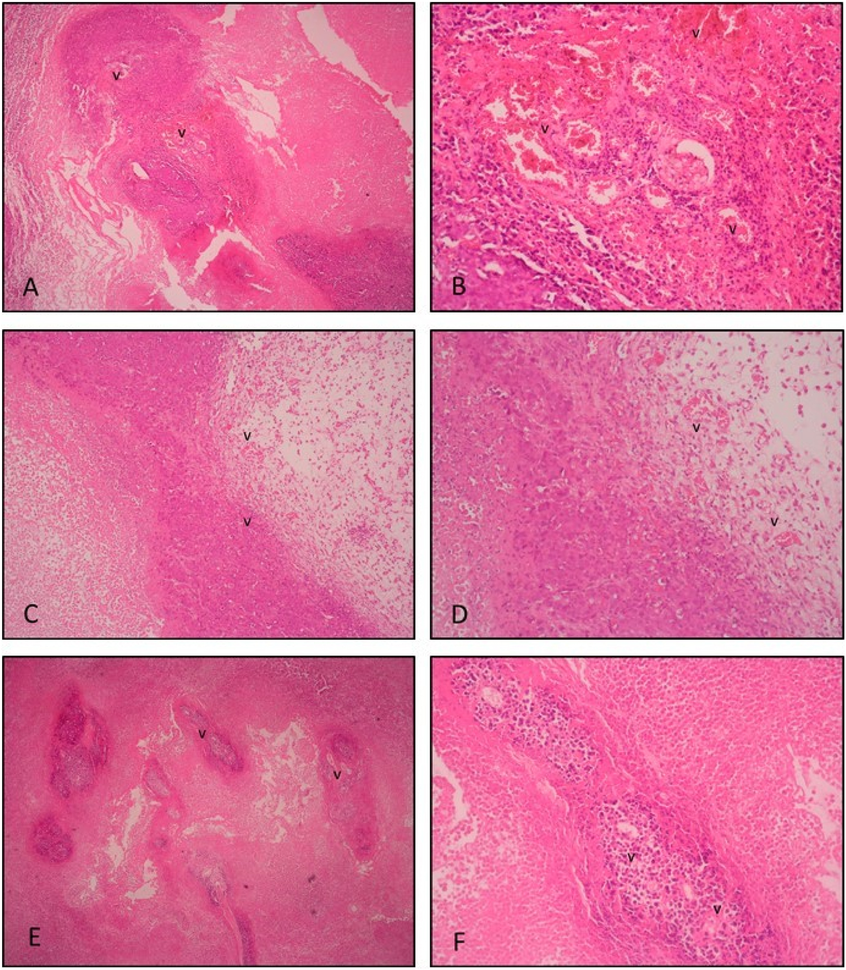 Figure 1:
H&E staining. Histological section of tumor tissue in the tumor control group; (A ×4, B ×20 magnification). Extensive inflammation and numerous hemorrhagic vessels are observed within and around the highly compacted tumor tissue. Histological sections of tumor tissue in the positive control (10 mg/kg suramin treatment) group; (C ×4, D ×20 magnification). Fewer vessels and inflammatory cells are seen within the decreased noncompact tumor tissue and surrounding stromal tissue compared to the tumor control group. Histological sections of tumor tissue in the post-implantation gossypol treatment group; (E ×4, F ×20 magnification). Less extensive compact tumor tissue is seen compared to the tumor control group. Fewer vessels and reduced inflammation are seen. v: vessel.