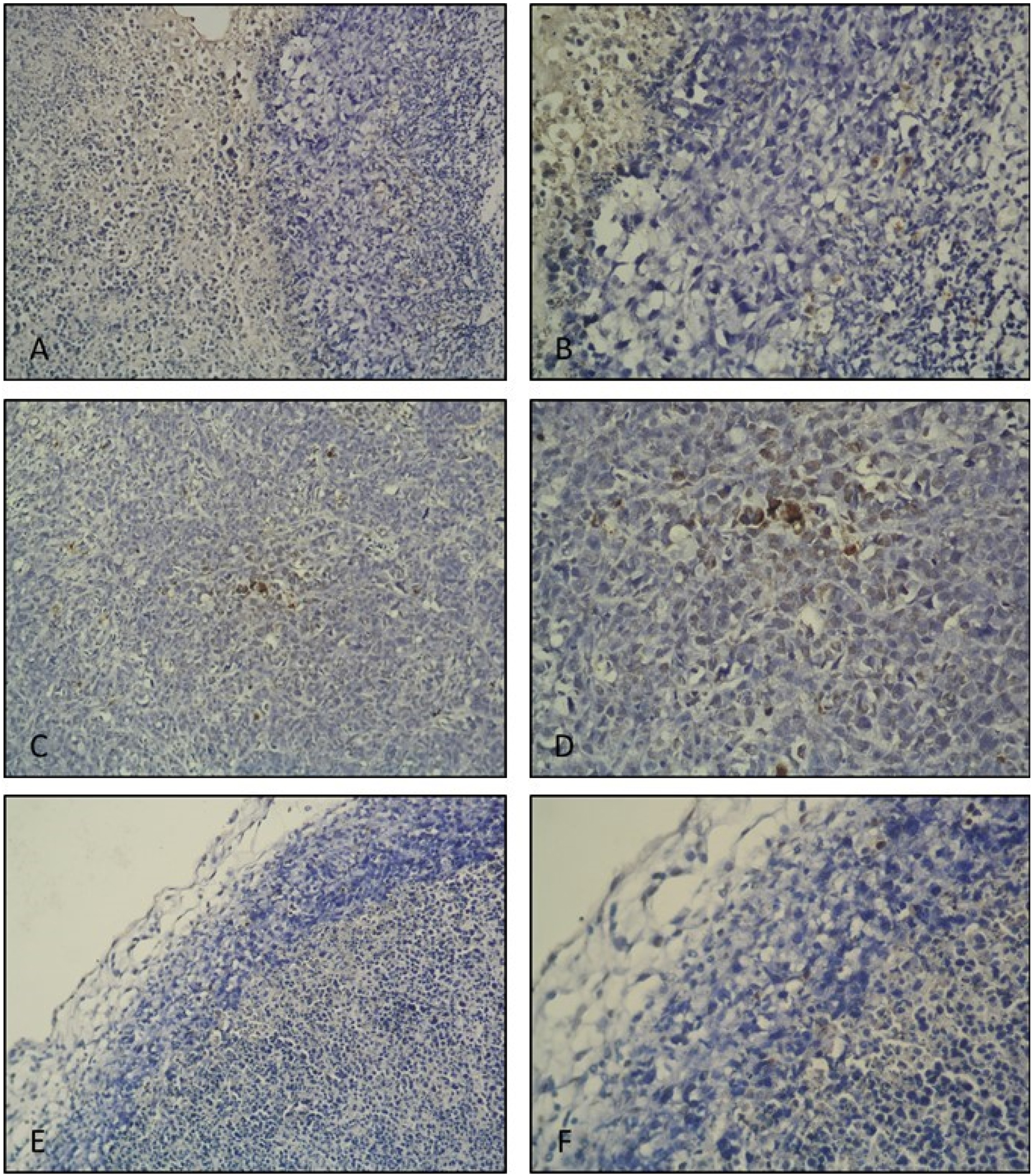 Figure 2:
TUNEL IHC staining. Tumor control group tumor tissue histological section; (A ×20, B ×40 magnification). Very few apoptotic cells are seen. Positive control (10 mg/kg suramin treatment) group tumor tissue histological section; (C ×20, D ×40 magnification). Apoptotic cells are observed densely within the tumor tissue. Post-implantation gossypol treatment group tumor tissue histological section; (E ×20, F ×40 magnification). Apoptotic cells are observed.