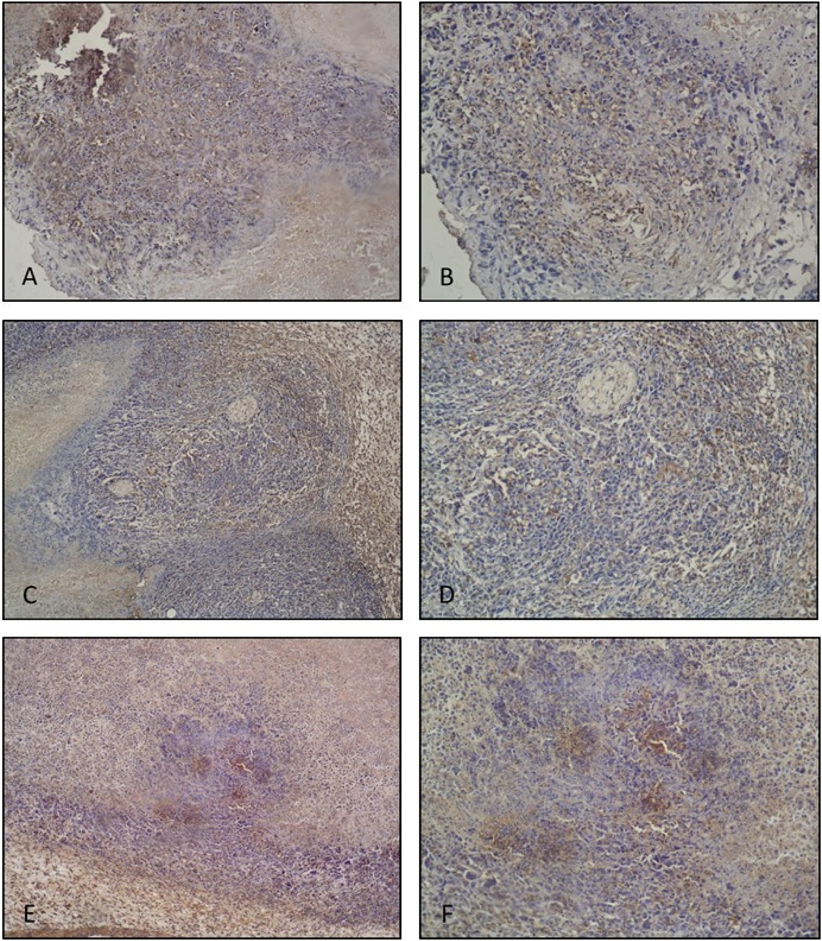Figure 3:
VEGF IHC staining. Tumor control group tumor tissue histological sections; (A ×10, B ×20 magnification). Quite intense and widespread VEGF expressions are observed. Positive control (10 mg/kg suramin treatment) group tumor tissue histological section; (C ×10, D ×20 magnification). Decreased VEGF expression is observed compared to the tumor control group. Post-implantation gossypol treatment group tumor tissue histological section; (E ×10, F ×20 magnification). Decreased VEGF expression is observed compared to the tumor control group.