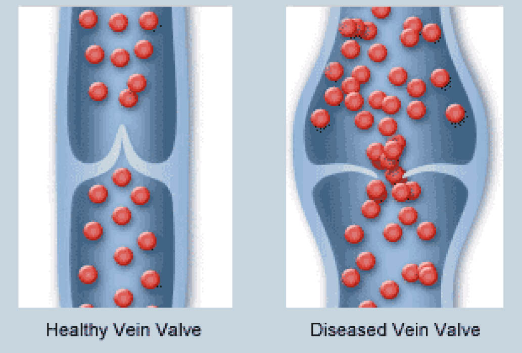 Figure 2. Comparison of reversible and irreversible blood flow [6]