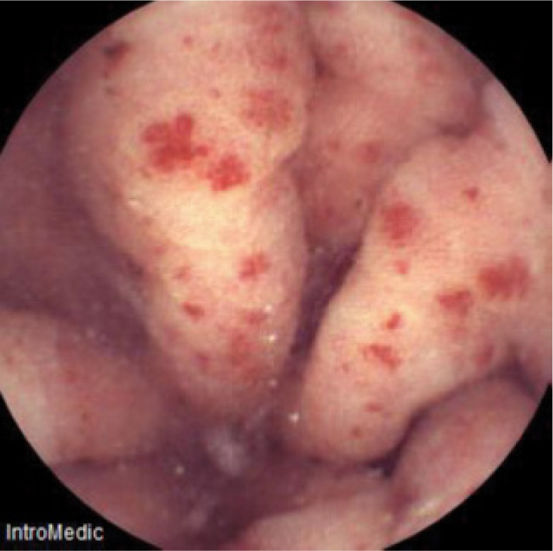 Figure 2 Picture obtained with capsule endoscopy (CE): multiple red punctuate lesions around the pylorus.
