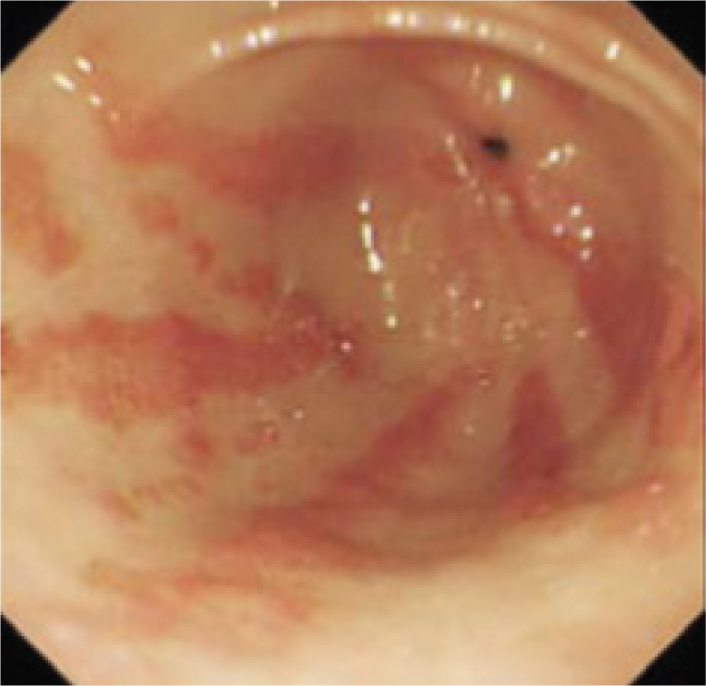 Figure 3 Striped watermelon appearance of gastric antral vascular ectasia.