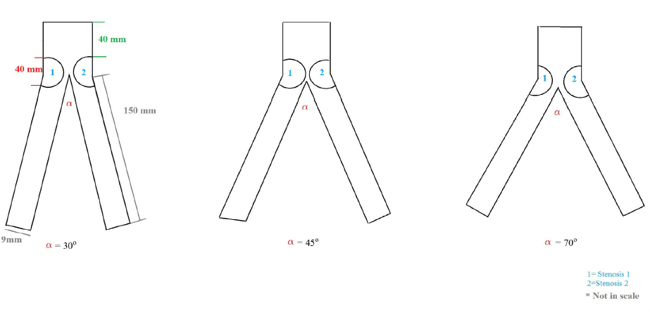 Figure 1 Schematic representation of the aortic Carrefour showing the considered angles and the fixed stenosis.