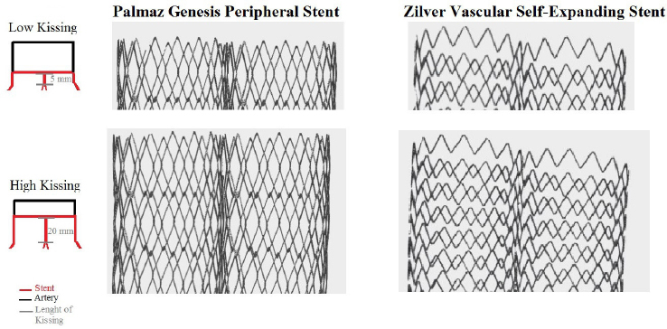 Figure 3 Schematic representation of the height of kissing applied to the analysis. Arterial walls have been subtracted to better represent the stent interactions.