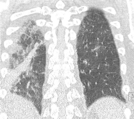 Figure 2 Thoracic tomodensitometry