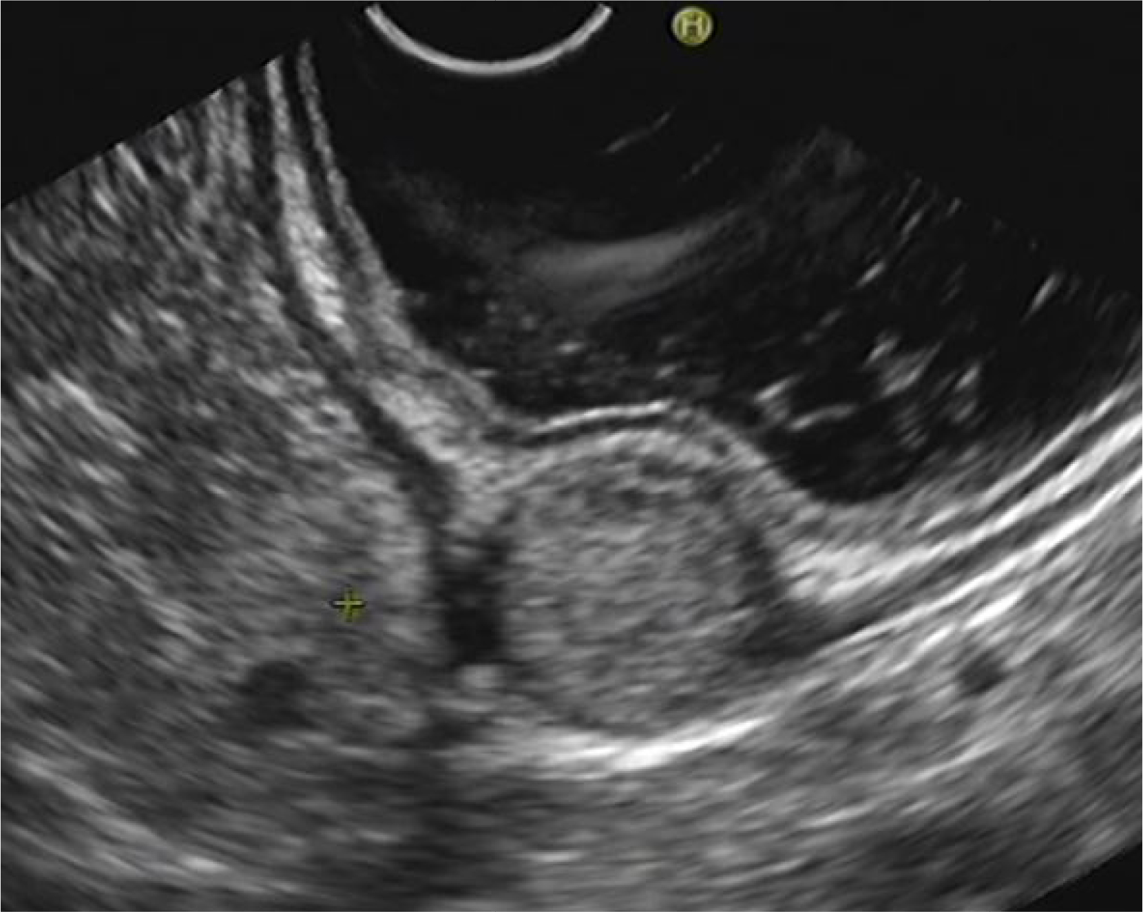 Figure 2 Gastric glomus lesions presented with mild-hyperechoic round or oval mass
