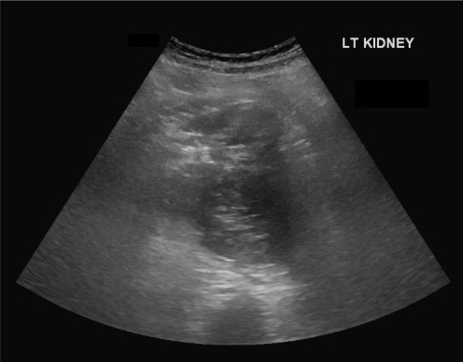 Figure 1 US KUB showing left kidney with loss of corticomedullary differentiation with a mass of mixed echogenicity.